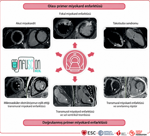 Şekil 12 Olası veya doğrulanmış primer miyokard enfarktüsünde kardiyak manyetik rezonans görüntülemenin rolü