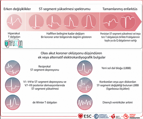 Şekil 9. Akut koroner oklüzyonun elektrokardiyografik özellikleri