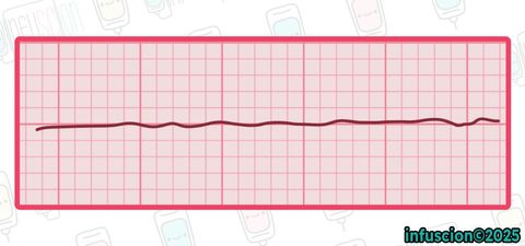 EKG: Asistol
