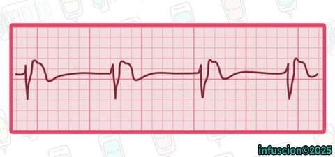 EKG: Nabızsız Elektriksel Aktivite