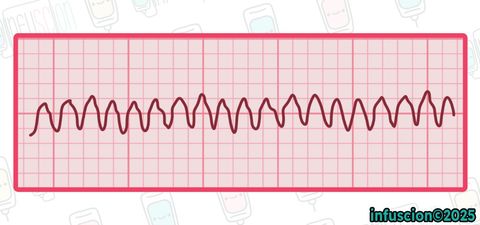 EKG: Ventriküler Taşikardi