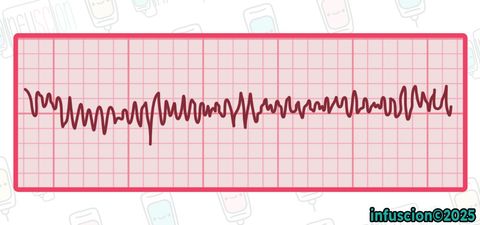 EKG: Ventriküler Fibrilasyon