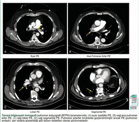 Pulmoner Tromboembolide BT-Anjiyografi Görüntüleri