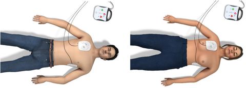 AHA: Defibrilasyon İçin Ped Yerleşimi