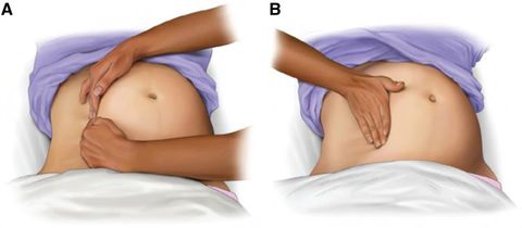 AHA: Resüsitasyon Sırasında 2 Elle (A) ve 1 Elle (B) Yapılan Manuel Sol Lateral Uterus Yer Değiştirmesi