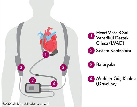 AHA: Abbott HeartMate 3 (HM3) Sol Ventriküler Destek Cihazı (LVAD)