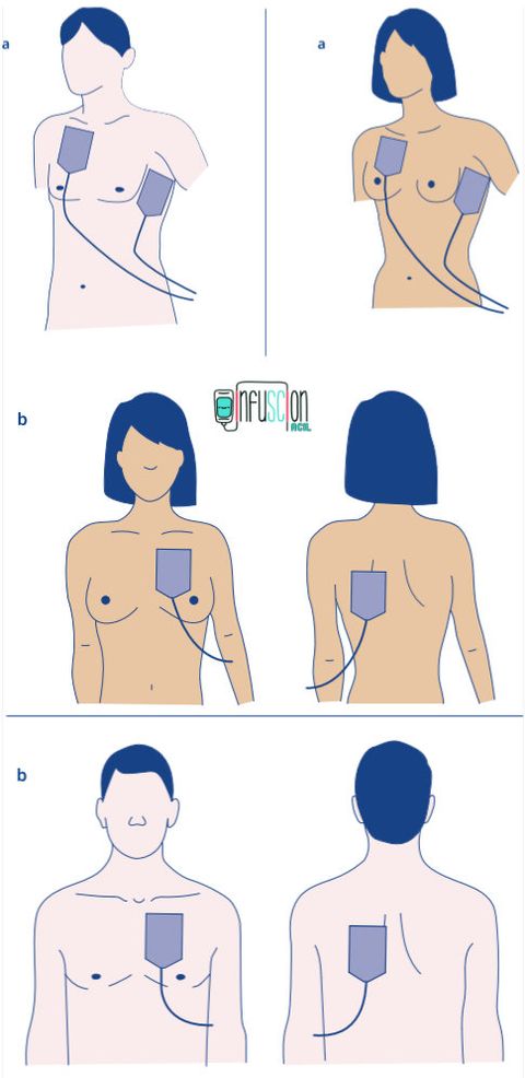 ERC: AED İçin Anterolateral (a) ve Anteroposterior (b) Ped Yerleşimleri