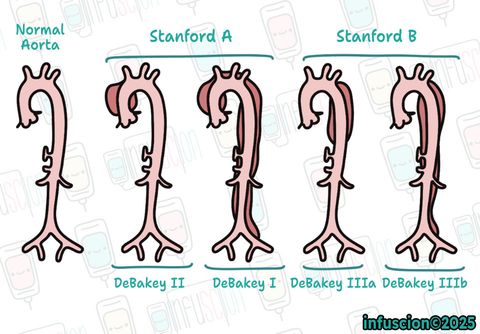 Aort Diseksiyonu Sınıflamaları