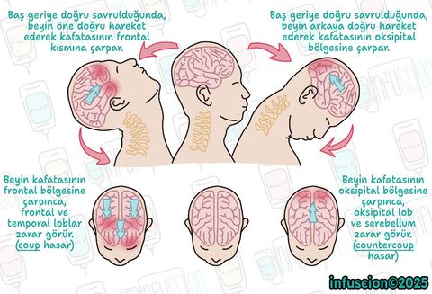 Kamçı Hareketi (Whiplash) ve Coup/Countercoup Hasarları