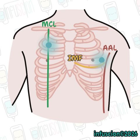 ATLS 11'e Göre İğne Dekompresyon Noktaları