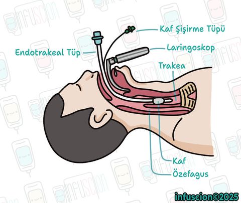 Endotrakeal Entübasyon