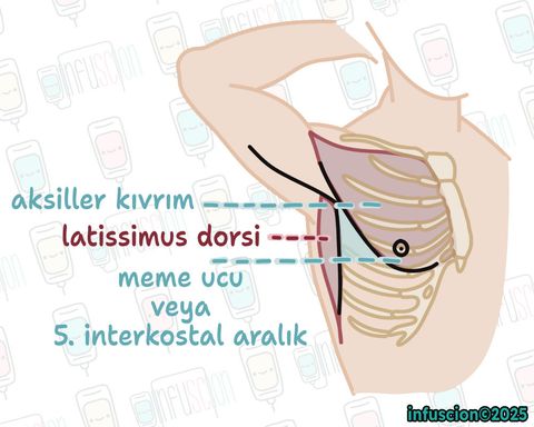 Torakostomide Güvenli Üçgen
